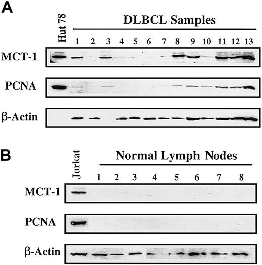 Figure 3. MCT-1 protein levels are increased in primary samples from a subset of patients. (A) Western blotting was carried out to detect MCT-1 and PCNA proteins from grossly involved lymph nodes of patients with newly diagnosed DLBCL. Seven of 13 specimens displayed elevated MCT-1 protein levels and were shown to correlate with increased PCNA levels. All 4 transformed lymphomas in our group demonstrated strong signals for MCT-1 protein (samples 3, 8, 9, and 11). (B) Ten normal lymph nodes examined had no detectable MCT-1 or PCNA. The Jurkat cell line served as a positive control for MCT-1 and PCNA protein expression.