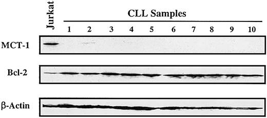 Figure 4. MCT-1 protein is not expressed in chronic lymphocytic leukemia. Western blotting was performed on 40 μg whole cell lysate with MCT-1 polyclonal antibody. All samples were isolated from peripheral blood of untreated patients (with more than 80% lymphocytes). Protein from Jurkat cells was served as MCT-1—positive control. Control immunoblotting with β-actin verified equal loading. Bcl-2 protein was universally expressed in the patients we analyzed. Peripheral lymphocytes from primary uncultured B-CLL samples demonstrated low to undetectable levels of MCT-1 protein.