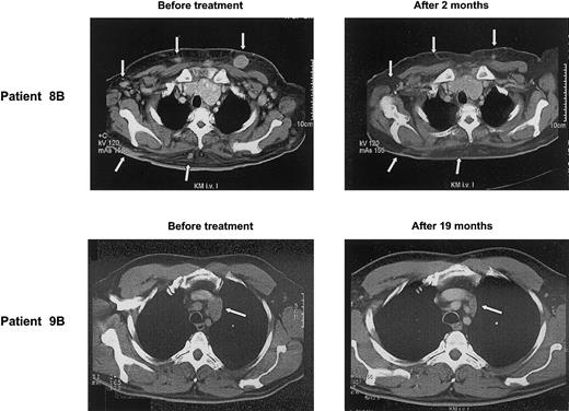 Figure 3. Clinical response to treatment. CT scans of patients 8B and 9B before and after several cycles of pamidronate/IL-2 therapy show regression of skin metas tases and mediastinal lymph node (arrows), respectively.