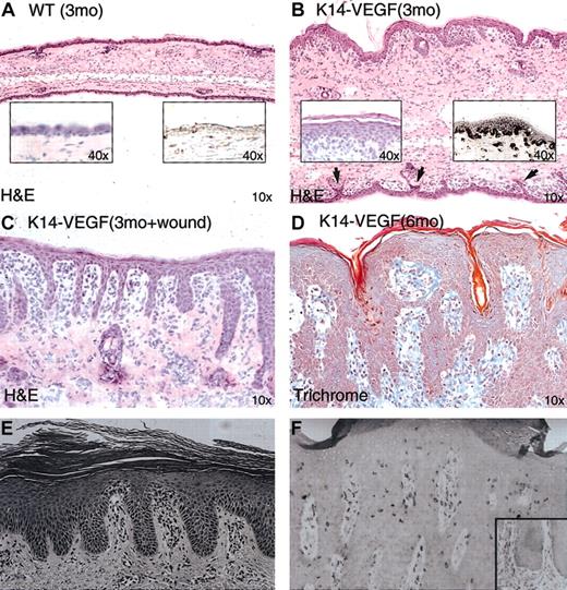 Figure 3. Histologic examination of ear skin from K14-VEGF transgenic mice, using H&E-stained tissue sections. (A) Control, wild-type littermate. Left inset shows epidermis at higher magnification; while right inset shows epidermis is negative for VEGF immunostaining. (B)Transgenic mouse (3 months of age) with edema, mild rete ridge formation on the ventral ear surface (arrows), epidermal acanthosis (left inset), and VEGF immunostaining in epidermis and in dermal microvessels (right inset). (C) Wound-induced rete ridge formation in a 3-month-old VEGF transgenic mouse. (D) Six-month-old VEGF transgenic mice showed spontaneous extensive rete ridge formation and anastomosis. (E) Early-stage human psoriasis shown for comparison. (F) Fully developed human psoriasis shown for comparison. Panels E-F reproduced with permission from Elder et al46 and Nickoloff and Wrone-Smith,23 respectively. Original magnifications: × 10 (A-D); and × 40 (insets).