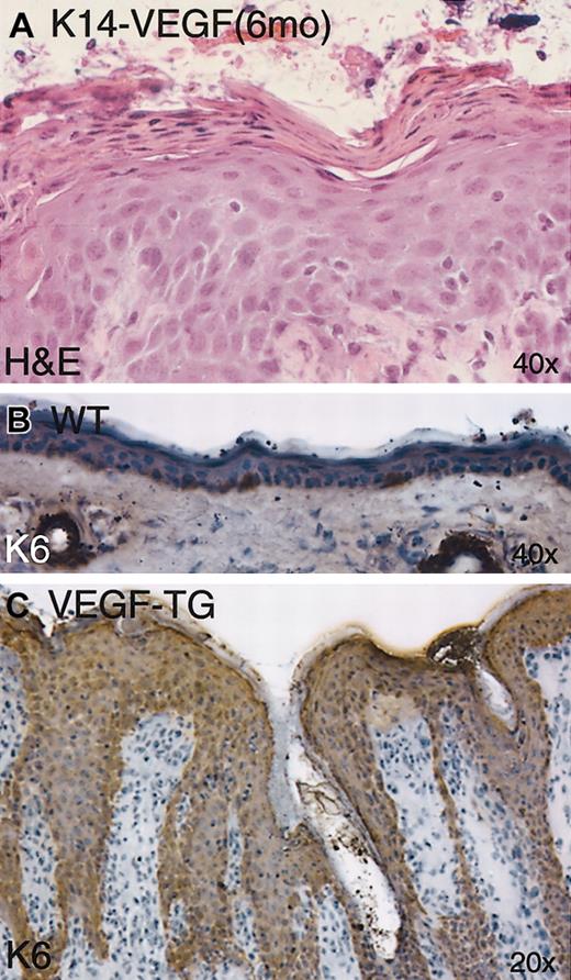 Figure 5. Abnormal epidermal proliferation and differentiation in K14-VEGF transgenic mice. Parakeratosis and hyperkeratosis were observed in H&E-stained skin sections from 6-month-old transgenic mice (A). Immunostaining of keratin K6 showed strong up-regulation throughout the epidermis (compare panels B and C) in 6-month-old transgenic mice.