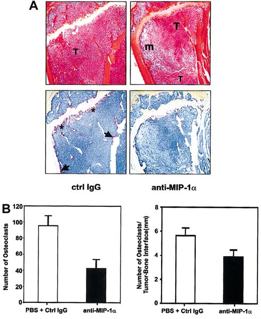 Figure 2. Inhibition of osteoclastic activity by anti-MIP-1α antibodies in myeloma-bearing mice. (A) Functional blockade of MIP-1α activity inhibited osteoclast formation and activity in tumor-bearing mice. Representative serial sections of tibiae of anti-MIP-1α antibody- and isotype IgG-treated mice stained with H&E (top row) or for TRAP activity (bottom row) were chosen to illustrate clear differences in osteoclast number and activity even when extent of tumor infiltration of marrow cavities was comparable. Note overall reduction in the number of osteoclasts and intensity of TRAP staining in the anti-MIP-1α section (right column), compared with the isotype IgG-treated section (left column). In the latter, osteoclasts are present not only on the primary spongiosum aspect of the growth plate (asterisks) but also along the endocortical surface (arrows). In contrast, in the anti-MIP-1α section, no osteoclasts are present on the endocortical surface and very few can be seen even where the tumor is apposed to the growth plate. Original magnification, × 10. T indicates tumor; m, marrow. (B) Histomorphometric analysis of osteoclast activity in bones of mice treated with anti-MIP antibodies or isotype-matched antibodies/PBS. Neutralization of MIP-1α bioactivity reduced osteoclast activity expressed either as total number of TRAP+ multinucleated osteoclasts aligned along the tumor-bone interface (left panel) or as number of osteoclasts per millimeter of tumor-bone interface (right panel).