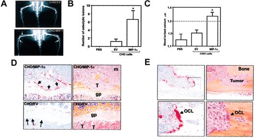 Figure 4. Osteolytic effects of MIP-1α in mice bearing intramedullary CHO/MIP-1α-secreting tumors induced by direct intracardiac inoculation of tumor cells. (A) Radiographs of lower limbs of nude mice 3 weeks after intracardiac inoculation of either CHO cell clones showing radiolucent lytic lesions (arrows) in a CHO/MIP-1α-bearing mouse but not CHO/EV mouse. (B) The number of lytic lesions in hind limbs of CHO/MIP-1α tumor-bearing mice was significantly greater than in control CHO/EV tumor-bearing mice. There were no lesions visible in mice injected with PBS. (C) Development of osteolytic lesions in CHO/MIP-1α tumor-bearing mice was associated with hypercalcemia. Whole blood ionized calcium levels in CHO/EV cells were not significantly different from those in mice injected with PBS. Upper limit of reference range for ionized calcium in nude mice: 1.3 mM (dashed line). See “Statistical analysis.” (D) Representative photomicrographs of tibiae of mice with intramedullary tumors induced by intracardiac inoculation of CHO/MIP-1α cells (top panels) and CHO/EV cells (bottom panels). Serial sections were stained with H&E (right panels) or stained for TRAP activity (left panels). A global increase in the number of TRAP+ osteoclasts is evident in the section of CHO/MIP-1α tumor-bearing mouse tibia, compared with that of tibia from mouse bearing CHO/EV tumor. An increased number of osteoclasts staining intensely positive for TRAP can be seen not only at CHO/MIP-1α tumor-bone interface but also along CHO/MIP-1α tumor-growth plate interface (short arrows). In the CHO/MIP-1α section, the marked increase in osteoclast activity is evident even on the primary spongiosum side of the growth plate where no tumor is present. In contrast, in the CHO/EV tumor, no osteoclasts are present even where the tumor is closely apposed to the growth plate (long arrows). T indicates tumor; gp, growth plate; m, normal marrow. Original magnification, × 20. (E) Representative photomicrograph of CHO/MIP-1α tumor in mouse tibia following induction of intramedullary metastases via intracardiac inoculation of CHO/MIP-1α cells, stained with H&E (right panels) or for TRAP activity (left panels). Top panels (at low original magnification, × 20) show a marked increase in number of TRAP+ osteoclasts evident all along the tumor-bone interface. In the bottom panels (depicting the inset) (at high original magnification, × 40), an intensely stained multinucleated osteoclast (OCL) is evident at the leading edge of the CHO/MIP-1α tumor.
