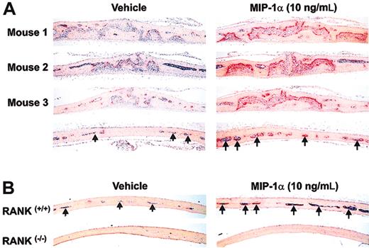 Figure 5. Recombinant MIP-1α induces osteoclast formation and bone resorption in vivo via RANK ligand (RANKL)/RANK signaling pathway. (A) Injection of 10 ng MIP-1α daily for 5 days into supracalvarial subcutaneous tissues in normal Swiss ICR mice resulted in a significantly increased number of osteoclasts (TRAP+; pink/red stained) and marrow spaces (arrows) compared with saline controls. Representative sections of calvariae from 3 separate mice are shown (each of the top 3 panels on either side represents the midsagittal suture area of calvaria of one mouse; bottom panels represent the region of calvariae away from the midline). (B) Although injection of MIP-1α induced osteoclast formation and bone resorption, represented by increased marrow spaces (arrows) in calvariae of wild-type litter-mates, it had no effect in RANK null mutant mice. Note lack of marrow spaces and bowing of calvariae of RANK-/- mice due to absence of osteoclasts.