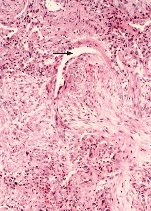 Figure 1. A polypoid tongue of fibrous tissue has reduced the lumen of the bronchiole to a slitlike space (arrow). Fibrosis extends into some alveolar sacs, and there is a mononuclear interstitial inflammatory infiltrate (hematoxylin and eosin stain; original magnification, × 80).