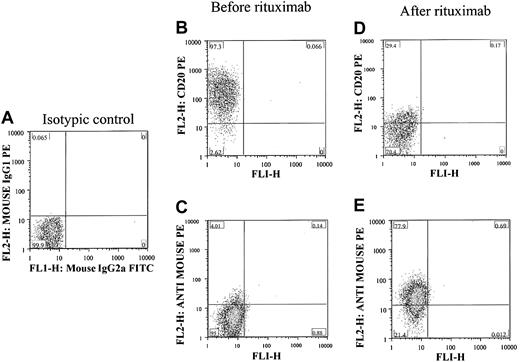 Figure 1. Ex vivo detection of rituximab on the surface of CLL cells. (A) Negative control and lack of staining noted when isotypic control antibodies were used to stain isolated lymphocytes from a patient with confirmed CLL. CD20 was detected in the gated lymphocytes before adding rituximab (B), and there was no detectable rituximab on the surface of cells using antimouse Ig antibodies (C). After adding rituximab, the cells became completely negative for CD20 (D) and strongly positive for rituximab using antimouse Ig sera (E). The percentage of cells in each quadrant is shown in each plot.