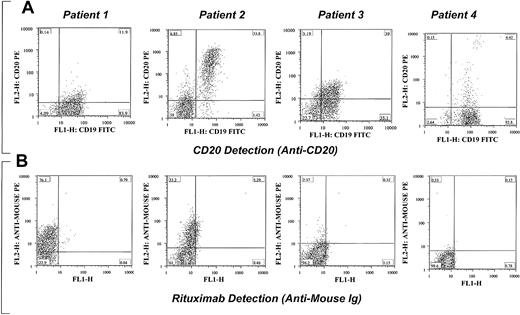 Figure 2. Examples of detection of rituximab and CD20 in 4 different patients with CLL being treated with rituximab. Varying degrees of masking of CD20 expression (A) and detection of rituximab (B) on CLL cells are shown. In patients 1 and 2 almost all the B cells are positive for rituximab, whereas no rituximab is detected on the surface of cells from patients 3 and 4. Some of the B cells were CD20+ despite the negativity for rituximab. All B cells were negative for both CD20 and rituximab, which suggests that CD20 is no longer expressed on the surface of cells rather than masking by the rituximab. CD20 expression was detected in more than 90% of CD19+ cells in all patients before therapy. The percentage of cells in each quadrant is shown in each plot.