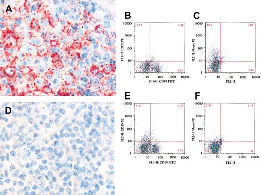 Figure 4. Detection of CD20 by immunohistochemical stains using L26 MoAb. L26 is positive (red) in a bone marrow lymphoid aggregate from a patient with CLL treated with rituximab (A). The B cells are surface CD20- (B), but rituximab positive (C), indicating masking of the surface CD20. In contrast, bone marrow from a different CLL patient is negative for L26 (D), surface CD20 (E), and rituximab (F), indicating absence of CD20 rather than masking. Original magnification, × 500 (A, D).