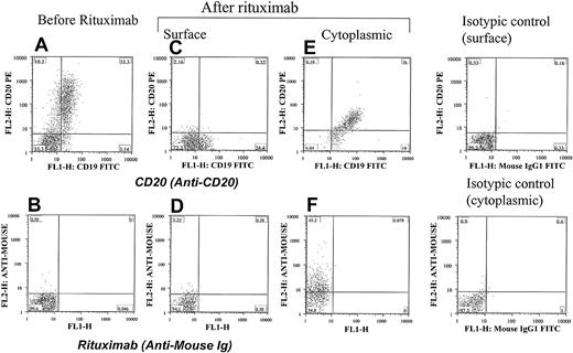 Figure 6. Internalization of CD20 and rituximab at the early stage of therapy with rituximab. Cells from a patient with CLL were positive for CD20 (A) and negative for rituximab (B) before therapy. They became negative for both CD20 (C) and rituximab (D) 24 hours after rituximab therapy. The same cells showed cytoplasmic positivity for both CD20 (E) and rituximab (F), confirming internalization of the CD20/rituximab complexes. Isotypic controls are shown. The percentage of cells in each quadrant is shown.
