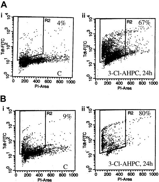 Figure 3. 3-Cl-AHPC-mediated apoptosis in leukemic cells assessed by flow cytometry. Leukemia cells of patient 1 (A) and patient 10 (B) were treated with 1 μM 3-Cl-AHPC (Aii,Bii) or vehicle alone (Ai,Bi) for 24 hours and harvested; then the percentage of apoptotic cells was determined by means of an Apo-Direct Kit. The percentage of apoptotic cells is indicated in the right hand corner in the vehicle-treated control (labeled C) and 3-Cl-AHPC-treated cells.