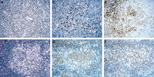 Figure 1. Patterns of NLPHL with T-cell/histiocyte-rich nodules. Pattern A (top row) and pattern B (bottom row). H&E (left column), CD20 (middle column), and CD21 (right column). Original magnification, × 10.