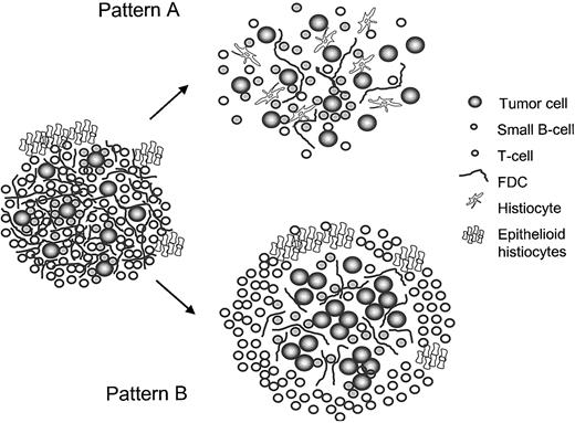 Figure 3. Schematic depiction of the 2 patterns of NLPHL with T-cell/histiocyte-rich nodules as possible pathways of morphologic progression of NLPHL.