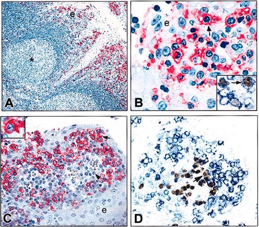 Figure 2. IRTA1 expression in paraffin sections from normal tonsil immunostained with the mAb M-IRTA1. (A) IRTA1+ cells are selectively distributed within the tonsil epithelium (e) and at the border of mantle zones. * indicates a IRTA1- germinal center. (B) IRTA1+ cells often show a villous cell surface (arrow). (Inset) Blue indicates staining for IRTA1; brown, the proliferation antigen MIB1. Most IRTA1+ intraepithelial B cells are not proliferating. The arrow points to a large IRTA1+/MIB1+ cell. (C) IRTA1+ B cells within the epithelium (e) often form a rim (arrow) around clusters of subepithelial plasma cells (arrowhead) arranged around small vessels. Inset shows higher magnification of an IRTA+ cell. (D) Double staining for IRTA1 (blue) and MUM1/IRF4 (brown) shows a rim of IRTA1+/MUM1- negative intraepithelial B cells surrounding a cluster of IRTA1-/MUM1+ subepithelial plasma cells (arrow). The APAAP technique was used in panels A-C; double immunoperoxidase/APAAP staining, panels D and B inset. Original magnifications × 100 (A); × 1000 (B, larger panel and inset); × 400 (C-D).