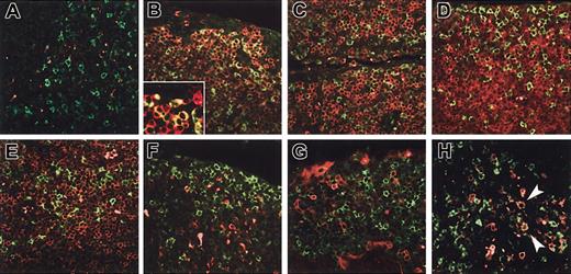 Figure 3. The phenotype of IRTA1+ tonsil cells. (A) Double immunofluorescence staining of tonsil sections. IRTA1 is green. Negative control is red. No double-positive cells are identified (yellow-green). (B) IRTA1+ cells are CD20+ B cells; (inset) higher power of the same. (C) CD79a is weakly coexpressed on IRTA1+ B cells. (D) BCL2 is weak or negative on IRTA1+ extrafollicular B cells. The epithelium surface is at the top edge of the image. (E) CD3 and IRTA1 do not costain. (F) CD68 labels macrophages but not IRTA1+ B cells. (G) IRTA1+ cells and CD138 are mutually exclusive. (H) Rare interfollicular large cells (arrowheads) are IRTA1+ (green)/CD30+ (red) (green + red = yellow). All immunostaining for IRTA1 was performed with the specific polyclonal antibody. Original magnifications: × 400 (A-H); × 1000 (B inset).
