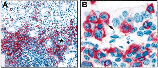Figure 6. IRTA1 expression in MALT lymphomas. (A) Gastric MALT lymphoma. Tumor cells forming lympho-epithelial lesions are IRTA1+. * indicates a gland lumen. Tumor cells located far from the glandular epithelium are IRTA1-. (B) Lympho-epithelial lesion in a MZ lymphoma of the lung. The arrow points to a IRTA1+ lymphoma cells invading the ciliated bronchial epithelium. The APAAP technique with mAb M-IRTA1 was used with a hematoxylin counterstain. Original magnifications × 200 (A); × 1000 (B).