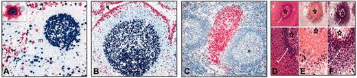 Figure 7. IRTA1 expression in reactive lymph nodes. (A) Double APAAP staining for IRTA1 (mAb M-IRTA1) and the proliferating antigen MIB1 in a reactive lymph node. IRTA1 strongly labels in red B cells (arrow) at the border of the mantle zone (m) while MIB1 (blue) is mainly expressed by germinal center B cells. A small percentage of double-stained IRTA1+/MIB1+ cells is present (arrowhead and inset). (B) Double APAAP staining for IRTA1 (mAb M-IRTA1) and BCL6 in a reactive lymph node. IRTA1 strongly labels in red B cells of the subcapsular sinus (arrow), whereas BCL6 (blue) is strongly expressed by germinal center B cells. (C) Monocytoid B cells of toxoplasmic lymphadenitis strongly express IRTA1 (APAAP technique with mAb M-IRTA1). (D-F) IRTA1 expression in human spleen. (D) Spleen stained with polyclonal anti-IRTA1 (H&E stain). The GC is marked by *; the marginal zone is bracketed in white. (E) Adjacent section stained for IRTA1 (black) and the B-cell antigen PAX5 (red nuclear staining). (F) Serial sections stained for IgD (black) and PAX5 (red). IRTA1+ B cells are distributed in the IgD-dim marginal portion of the marginal zone. Other areas are negative. Original magnifications × 100 (A); × 1000 (A inset); × 200 (B); × 100 (C); × 100 (D-F, top); × 400 (D-F bottom).