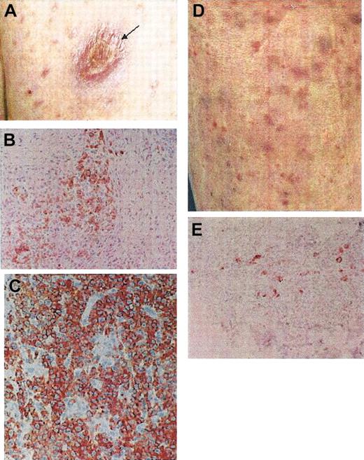 Figure 1. Clinical and histopathologic features of the 2 patients with LyP. Case 1 (A-C) and case 2 (D-E). Arrow in panel A shows the tumor of ALCL; the papular lesions in panels A and D represent LyP. Panels B and E show positive CD30 staining of atypical lymphoid cells in LyP. Panel C shows a more massive infiltration and pronounced atypia of CD30+ cells in ALCL. Original magnification, × 200 (B,C,E).