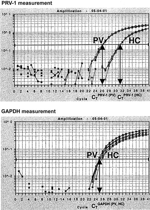 Figure 1. Quantification of PRV-1 mRNA by Taqman RT-PCR. Total RNA (5 ng) from a PV patient (PV) and from a healthy control (HC) was subjected to quantitative RT-PCR for PRV-1 and GAPDH in an ABI PRISM 7700 Sequence Detection System. Fluorescence emitted during the PCR amplification (y-axis) is plotted against the cycle number (x-axis). For each reaction, the cycles of threshold (CT) are determined when a preset level of fluorescence is reached: one CT is obtained for PRV-1, another for GAPDH. The PRV-1/GAPDH ratio of a sample is determined by dividing the CTPRV-1by the CTGAPDH.