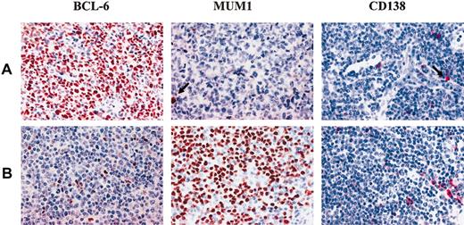Figure 2. Expression of BCL6, MUM1, and CD138 in monoclonal B-cell PTLDs. (A) Diffuse large B-cell lymphoma with centroblastic morphology displaying the BCL6+/MUM1-/CD138- phenotypic pattern. Medium-sized tumor cells show a nuclear staining pattern with the anti-BCL6 MoAb. Residual plasma cells show nuclear brown staining for anti-MUM1 antibody and cytoplasmic red staining for anti-CD138 MoAb (arrows). (B) Diffuse large B-cell lymphoma with centroblastic morphology displaying the BCL-6-/MUM1+/CD138- phenotypic pattern. Most neoplastic cells show strong nuclear immunoreactivity with the anti-MUM1 antibody. No BCL6 expression is detectable in the neoplastic population; residual plasma cells show cytoplasmic staining for anti-CD138 MoAb. Paraffin-embedded tissue sections, immunoperoxidase method (BCL6, MUM1), APAAP method (CD138), hematoxylin counterstain. Original magnification, × 250.