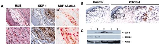 Figure 1. SDF-1 and CXCR-4 expression in cutaneous KS lesions. (A) Parallel sections from a formalin-fixed biopsy of an AIDS-KS skin lesion stained with hematoxylin and eosin (H&E) for SDF-1 and double stained for KSHV-LANA/SDF-1. H&E staining reveals normal epidermis overlaying a spindle cell proliferation consistent with cutaneous involvement with KS. SDF-1 immunostaining reveals intensely positive spindle cells within the KS lesion (dark arrow); endothelial cells lining skin capillaries (open arrow) and dendritic cells (arrowhead) in the skin overlaying the KS lesion are also SDF-1 positive. Original magnifications, × 40 (i,ii) and × 60 (iv,v). (iii,vi) Double staining for KSHV-LANA (red) and SDF-1 (brown) reveals that spindle cells confined to the KS lesion are positive for both LANA and SDF-1 (original magnification, × 100). (B) Parallel sections from a frozen biopsy of an AIDS-KS skin lesion stained with antihuman CXCR-4 monoclonal antibody or control monoclonal antibody. CXCR-4–specific immunostaining is confined to scattered cells within superficial dermis. Original magnifications, × 20 (left and middle panels) and × 100 (right panel). (C) Western blot analysis of SDF-1 and CXCR-4 expression in tissues and cell cultures detected by specific antibodies against SDF-1 and CXCR-4. Cell lysates were obtained from BL41 cells (lane 1), HUVECs (lane 2), KS tissue from 2 patients (lanes 3-4), and normal skin (lane 5). Protein loading was evaluated by reprobing the membrane with anti-actin antibodies.
