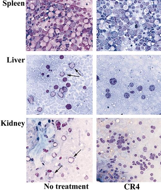 Figure 5. CR4 inhibits tissue infiltration of Ph+ ALL cells in vivo. Tissue-touch preparations were prepared from the organs of CR4-treated and control mice after 3 weeks and stained with Wright-Giemsa stain. The spleen, liver, and kidney of control mice demonstrate significant infiltration with ALL blast cells, whereas CR4-treated organs are essentially normal and devoid of ALL cells. Original magnification, × 400. Arrows indicate blasts.