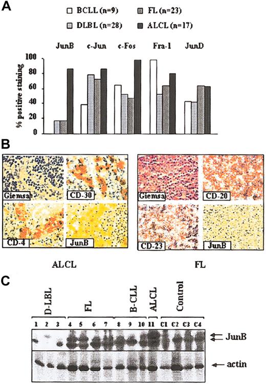 Figure 1. Expression of the AP-1 family members JunB, c-Jun, c-Fos, Fra-1, and JunD in human lymphomas. (A) Tissue array analysis from 77 human lymphomas samples including B-cell chronic lymphoid leukemia (B-CLL; n = 9), diffuse large-cell lymphomas (D-LBLs; n = 28), follicular lymphomas (FLs; n = 23), and anaplastic large-cell lymphomas (ALCLs, n = 17). Histogram bars indicate the percentage of each lymphoma entity with high expression of JunB, c-Jun, c-Fos, Fra-1, and JunD. (B) Immunohistologic staining of an ALCL (left) and of an FL (right). Transformed T cells in ALCL show a strong staining for CD4, CD30, and JunB. The tumor cells in FL stain positive for CD20 and CD23 but not for JunB. Original magnification, × 600. Stains were performed using DAB (3,3 Diaminobenzidin) for JunB and APAAP for all other antibodies. (C) Western blot analysis of lymph nodes from patients suffering from different B-cell malignancies for JunB expression. Lanes 1-3 indicate diffuse large-cell lymphomas (D-LBLs); lanes 4-7, follicular lymphomas (FLs); lanes 8-10, B-cell chronic lymphoid leukemia (B-CLL); lane 11, ALCL; and lanes C1-C4, control lymph nodes.