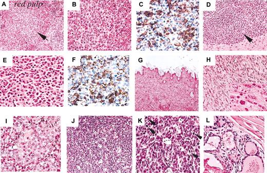 Figure 4. Histopathology of tumors in Fancc and Trp53 intercrossed mice. (A-F) Myeloid malignancy (histiocytic sarcoma) in a Fancc-/-Trp53+/- mouse. (A-B) Malignant histiocytes are observed in the red pulp of the spleen, indicated in panel A by the arrow. (C) Immunohistochemical characterization demonstrates that the malignant cells within the spleen are Mac-2+. (D-E) Malignant histiocytes are also observed in the liver as indicated by the arrow. (F) The malignant cells are shown to be Mac-2+ by immunohistochemical staining. (G-H) Dermal spindle cell tumor from the neck of a Fancc-/-Trp53+/- mouse shows a high mitotic index and undifferentiated cells with cigar-shaped nuclei. (I) Ovarian tumor from a Fancc-/-Trp53+/- mouse showing nests of round, tumor cells with rounded, pale nuclei. (J-K) Medulloblastoma of the cerebellum from a Fancc-/-Trp53-/- animal. Characteristic neoplastic cells with carrot-shaped nuclei, hyperchromatic coarse chromatin, and almost nonvisible cytoplasm, with frequent mitotic figures (indicated by arrows) are arranged in sheets with pseudo-rosette formations visible. (L) Adenocarcinoma of the prostate of a Fancc-/-Trp53-/- mouse shows malignant cells arranged in irregularly shaped glandular structures invading surrounding smooth muscle. Original magnifications: × 100 (G); × 200 (A,D,H,J); × 400 (B-C,E-F,I,K-L); and × 600 (H inset).