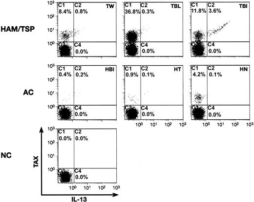 Figure 4. Activation of IL-13 synthesis in CD4+ T cells infected with HTLV-1 in vivo. Blood was drawn and PBMCs were prepared from 3 HAM/TSP patients, 3 asymptomatic carriers (AC), and 1 HTLV-1-negative donor (NC). Cells were cultured for 24 hours in medium containing brefeldin A and concanamycin A but lacking mitogens. Cells were then stained with fluorescent-tagged antibodies directed against cell surface CD4+ or intracellular IL-13 and HTLV-1 Tax proteins and analyzed by flow cytometry. Fluorescence intensities of Tax versus IL-13 are plotted for cells gated as CD4+. Neither Tax nor IL-13 signals were observed using matched isotype control antibodies. Patient designations are shown in the upper-right corner of each quadrant.