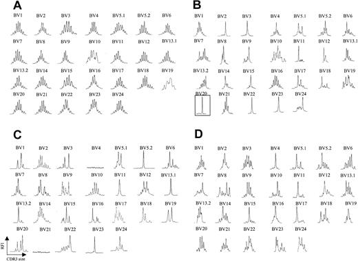Figure 1. TCR BV CDR3 spectratyping profiles are strongly restricted in CTCL patients. (A) CDR3 spectratypes of CD3+ T cells from a representative healthy donor showing highly diverse profiles, reflecting a heterogeneous TCR repertoire. (B) A patient with stage III CTCL with a numerically expanded malignant clone (BV 20), demonstrating multiple monoclonal and oligoclonal profiles. (C-D) Similarly contracted profiles as well as some apparent deletions (BV 4, BV 21) are also found in patients with stage III CTCL without a numerically expanded clone (C) and even in some patients with stage IA CTCL (D). The y-axis represents relative fluorescence intensity (RFI), and the x-axis is CDR3 size (nucleotides).