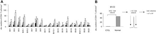 Figure 4. BV+ CD4+ T cells are markedly depleted in CTCL. (A) The absolute number of BV+ CD4+ T cells was calculated by determining the percentage of BV+ CD4+ T cells by flow cytometry and obtaining absolute CD4 cell counts. The means ± SDs of stage III/IV (▪; n = 10, without the numerically expanded clones) and stage I/II (▦) CTCL patients (n = 7) are shown in comparison to normal values (□) for each BV subfamily. Normal values represent the average number of CD4+ T cells (1100/mm3)26 and the normal mean percentage of BV+ CD4+ T cells in adult blood (mean ± SD are from a cohort of 85 normal specimens, according to Beckman Coulter). With the exception of BV 23 a markedly decreased number of BV+ CD4+ T cells were observed, particularly in patients with stage III/IV CTCL. (B) The combination of the reduction of absolute CD4+ values of specific BV subfamilies with a corresponding monoclonal spectratype profile reveals that a further depletion of BV 22+ CD4 T cells is actually present in this subfamily. An instructive example is shown.