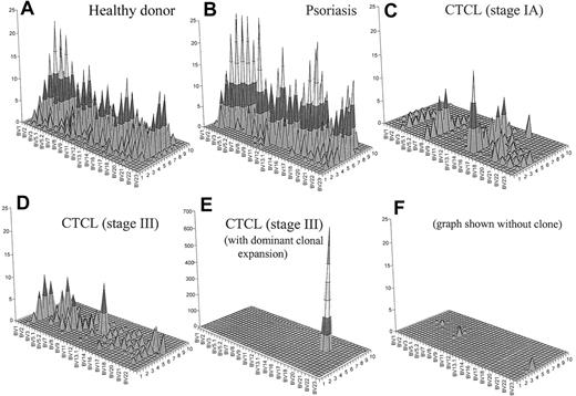 Figure 5. Combination of a qualitative (CDR3 spectratyping) and quantitative (flow cytometry) analysis of the TCR repertoire. These graphs give a better visual assessment of the global reduction of the TCR diversity in CTCL. Panel A shows an overall diverse polyclonal CDR3 profile from a representative healthy donor. Panel B demonstrates a similarly diverse profile from a patient with psoriasis. Panel C shows a patient with CTCL with early-stage disease. The loss of complexity is evident even at this stage of disease in the absence of an expanded clone by FACS. Panel D shows a similarly restricted profile from a patient with stage III CTCL without a numerically expanded clone. (E) A highly restricted profile from a patient with CTCL with a malignant clone. (F) With this clone subtracted from the landscape, there is still very little background complexity. The x-axis displays the 24 BV subfamilies, the z-axis shows the CDR3 length distribution (in amino acids), and the z-axis indicates the absolute number of BV+ CD4+ T cells per cubic millimeter.