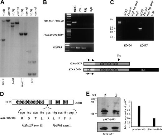Figure 1. PDGFRB is fused to PDE4DIP in an MPD associated with eosinophilia and t(1;5)(q23;q33). (A) Southern blot analysis of the t(1;5) and control DNA with a HindIII-XhoI PDGFRB genomic probe spanning exon 11. Rearranged bands are indicated by a star. Cloning of the genomic breakpoints for this fusion confirmed that the wild-type PDGFRB and PDE4DIP-PDGFRB HindIII restriction fragments are of very similar size and, therefore, comigrated in the Southern blot. At DNA level, the fusion of these genes occurs at IVS 12-767 (PDE4DIP) and IVS 10+289 (PDGFRB). (B) Single-step RT-PCR confirms the expression of the PDE4DIP-PDGFRB fusion. The reciprocal fusion is not expressed. PDGFRB RT-PCR confirms the integrity of the cDNAs. (C) Top: Isoform-specific nested RT-PCR showing that the PDE4DIP isoform lacking the LZ domain (KIAA 0477) is fused to PDGFRB in the t(1;5). Below: Diagram of the primary protein structure of human myomegalin, putative oligomerization domains, the breakpoint in the t(1;5), and the location of the primers (horizontal arrows) used in the isoform-specific nested RT-PCR. (D) Diagrammatic representation of the myomegalin (MM)-PDGFRB protein fusion and contributing nucleotides, amino acids, and domains. (E) Left panel: Western blot analysis showing lower levels of phosphorylated AKT (top subpanel) in the patient's primary cells 2 months into imatinib treatment. Total AKT is shown in the lower subpanel. Right panel: Densitometry of relevant bands showed a 60% reduction in the expression of phospho-AKT after imatinib.