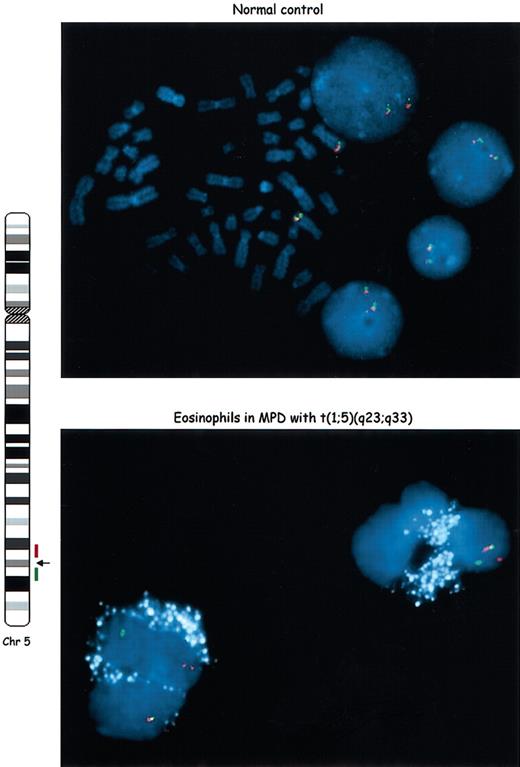 Figure 2. The eosinophils have a rearranged PDGFRB locus and are part of the neoplastic clone. We used a two-color interphase FISH assay in an eosinophil-enriched preparation to define the clonality of these cells. Differentially labeled BAC clones located centromeric (red) or telomeric (green) to the PDGFRB breakpoint region in the t(1;5) were used as probes. Schematic representation of chromosome 5, location of breakpoint and probes is shown on the left side. In normal metaphases and interphases (top panel) the red and green signals are juxtaposed (yellow) in both chromosomes 5. In the patient's peripheral blood eosinophils (bottom panel), one pair of signals is juxtaposed (normal chromosome 5), whereas the other signals are split, indicating rearrangement of the PDGFRB locus. The eosinophilic granules were pseudo-colorized in white because of their auto-fluorescence. Original magnification, × 1000.
