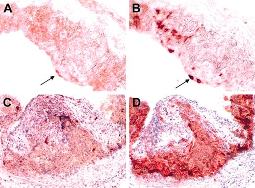 Figure 4. Representative photomicrographs showing atherosclerotic lesions in the aortic sinus of CD2-dnTGFBRII LDLr KO mice. CD1 staining was detected using antimouse goat polyclonal CD1 antibody (arrow in panel A). Only few CD1+ dendritic cells were detected. Although these cells expressed MHC class II (arrow in panel B), most of the MHC class II-positive cells stained negative for CD1 in an adjacent section (B). (C) MHC class II expression detected by staining with antimouse MHC class II. (D) Adjacent section stained with MOMA-2 to detect macrophages and foam cells. Most of the macrophages staining positively for MHC class II were disposed at the margins of the lipid core. Original magnification, × 400 (A-B); and × 200 (C-D).
