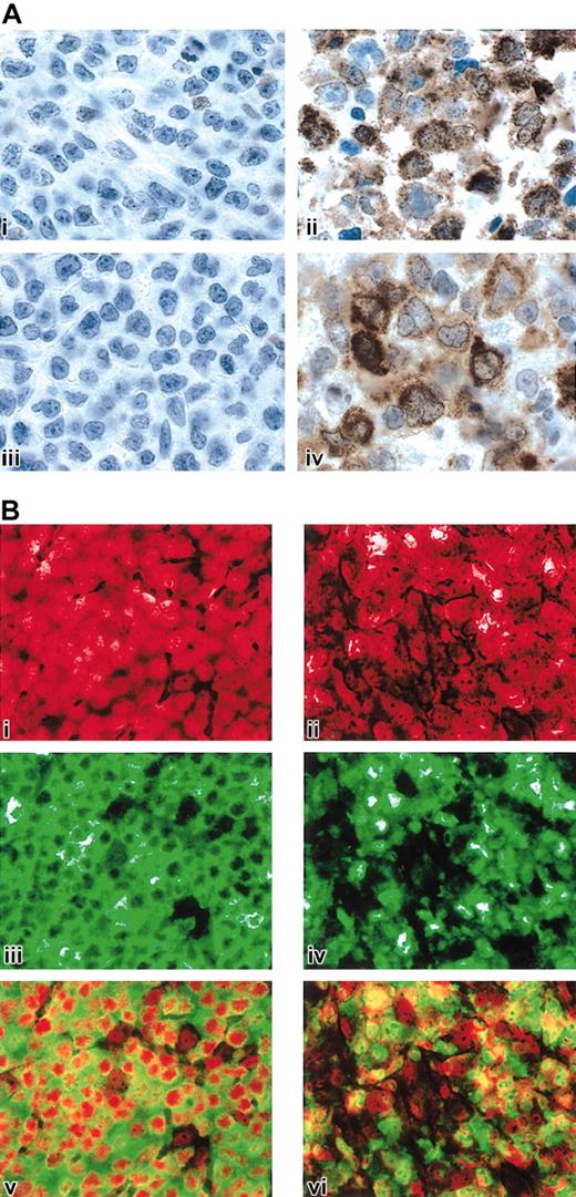 Figure 4. STAT1, TRAF1, and c-REL immunohistochemistry in MLBCL. (A) STAT1 and TRAF1 proteins in MLBCL. A control DLBCL (i, iii) and representative MLBCL (ii, iv) were stained for STAT1 (i, ii) and TRAF1 (iii, iv). Original magnification, × 1000. (B) c-REL immunohistochemistry in MLBCL. A control DLBCL (i,iii,v) and representative MLBCL (ii,iv,vi) are doubly stained for c-REL (iii,iv; green) and propidium iodide (i,ii; nuclear, red). The 2 channels of each case are superimposed in subpanels v and vi. Note predominant nuclear c-REL staining of MLBCL at right (vi) compared with the predominantly cytoplasmic c-REL staining of the control DLBCL on the left (v). Original magnification, × 400.