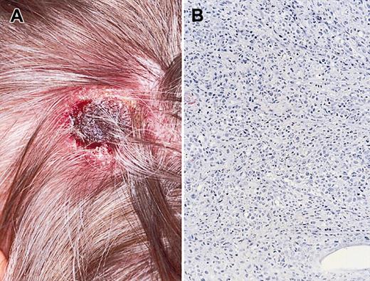 Figure 1. Clinical presentation and histologic section of the skin tumor stained with hematoxilin and eosin showing diffuse proliferation of large atypical blasts. Clinical (A) and histologic (B) presentation of primary cutaneous EBV+ lymphoproliferative disease. Original magnification, × 200 (B).