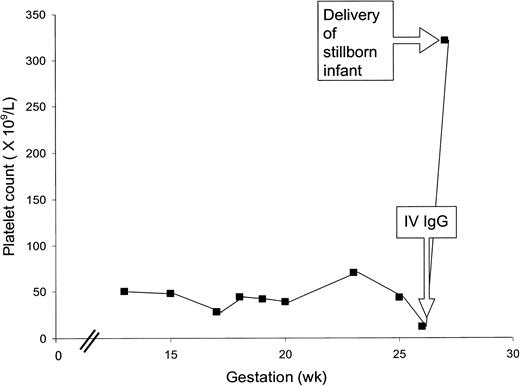 Figure 4. Flow chart of platelet counts during pregnancy of a woman giving birth to a stillborn infant with evidence of hemorrhagic complications. The patient had moderately severe ITP, easy bruising, and petechiae during pregnancy. She received an infusion of IV IgG at 26 weeks. At 27 weeks, the fetus was delivered as a stillbirth with evidence of extensive hemorrhage throughout the body and brain.