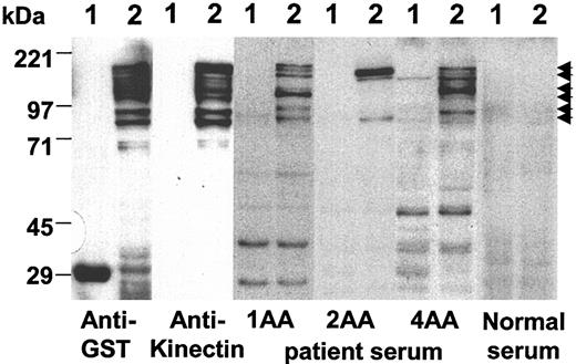 Figure 4. Sera from AA patients show different positive patterns for recombinant GST-full-length kinectin protein on Western blot analysis. Equal amounts of bacterial lysates expressing GST (lane 1) and GST-full-length kinectin fusion protein (lane 2) were separated by 9% SDS-PAGE, transferred to PVDF filters, and probed with mouse anti-GST monoclonal antibody, antikinectin monoclonal antibody, AA patient sera, or normal sera. Immunoreactive proteins were detected with horseradish peroxidase-conjugated goat antimouse or antihuman IgG secondary antibody. Arrows indicate the immunoreactive GST-kinectin fusion proteins.