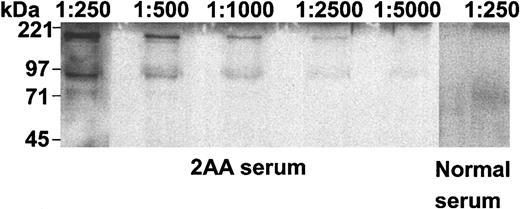 Figure 5. Sensitivity of 2AA patient serum reactivity against GST-kinectin fusion protein. Equal amounts of bacterial lysates containing GST-full-length kinectin fusion proteins were separated by 7.5% SDS-PAGE, transferred to PVDF filters, and probed with patient 2AA sera (diluted at 1:250 to 1:5000) or normal serum diluted at 1:250. Immunoreactive proteins were detected with horseradish peroxidase-conjugated goat antihuman secondary antibody.
