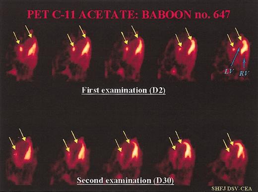 Figure 4. Representative PET examination. Ten-minute static PET myocardial images obtained 6 minutes after injection of C-11 acetate in a treated baboon. Each time, we can compare 5 consecutive transverse myocardial slices from the top (2 days after coronary artery ligation) to the bottom (30 days after myocardial infarction) of the heart: (LF) = left ventricle, (RV) = right ventricle. At day 2, we can see a large, nonviable antero-lateral myocardial infarction (between the 2 arrows in yellow). The mean value of myocardial blood flow decreased in the infarcted area (0.28 mL/min/g of tissue versus 0.75 mL/min/g of tissue in the remote, noninfarcted areas). At day 30, there was a slight increase in tracer uptake in the center of the necrotic zone, but also a clear increase in tracer uptake in the peripheral regions of the necrotic lesion, which led to a reduction of the infarct size (indicated by yellow arrows). At this time, MBF was 0.71 mL/min/g of tissue in the necrotic area versus 0.88 mL/min/g of tissue in the remote areas.
