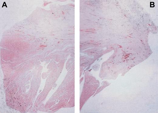 Figure 7. Evaluation of cardiac tissue in fibrosis in infarct zone. Two months after coronary artery ligation, staining with hematoxylin/eosin demonstrated in animals (A) that received or (B) did not receive growth factors similar scar aspects composed of paucicellular, dense, fibrous tissue; the digital image analyzer software, LUCIA, allowed a similar ratio of cardiac tissue (dark pink) included in fibrosis (slight pink) to be calculated.