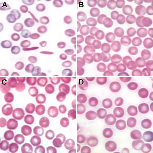 Figure 4. Correction of abnormal RBC morphology in lenti/βAS3 rescued transplants. (A) Blood smear from a mock-transplanted animal with characteristic sickled erythrocytes and a pronounced reticulocytosis. (B-C) Two representative primary transplant recipients of βAS3-transduced stem cells. No sickled cells were observed in any fields examined. (D) Wild-type C57Bl6 control. Original magnification × 120. Blood smears were stained with Wright-Giemsa.