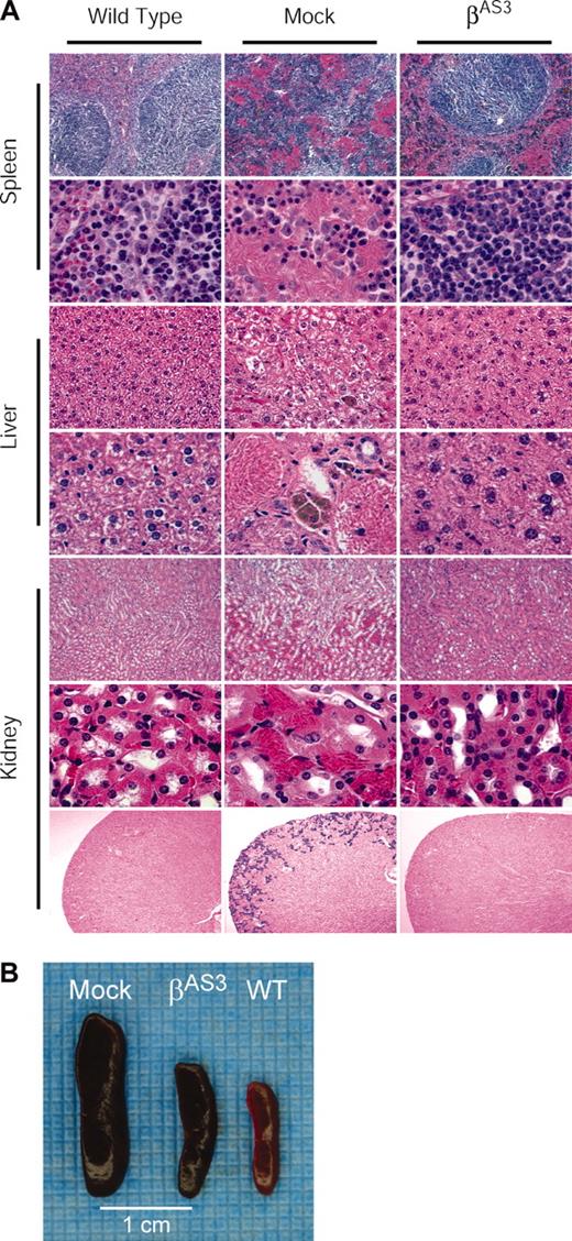 Figure 5. Amelioration of spleen, liver, and kidney pathology in lenti/βAS3 mice.(A) Spleen, liver, and kidney sections were analyzed at low (original magnifications are × 10 for spleen and kidney and × 40 for liver; top 3 rows and bottom row) and high magnification (original magnification, × 100; bottom rows for spleen and liver and the middle row for kidney). In lenti/βAS3-transduced mice, normal splenic red and white pulp is observed and virtually no pools of sickle erythrocytes or infarcts are evident. In livers of lenti/βAS3 animals, focal areas of necrosis and aggregation of sickled erythrocytes are not observed; also, extramedullary hematopoiesis and hemosiderin deposition are absent. Kidneys of lenti/βAS3 mice appear normal and free of the disruptive vascular RBC pooling and hemosiderin deposits observed in mock-treated animals. (B) Correction of splenomegaly in lenti/βAS3-transduced mice. All sections except the bottom panel were stained with hematoxylin-eosin; the bottom panel was stained with Gomori iron.