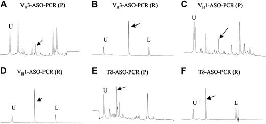 Figure 4. ASO-PCR analysis using DNA 500 chip in case 472. U indicates upper marker; L, lower marker; P, presentation sample; and R, relapse sample. (A) IgH (VH3) gene rearrangement from diagnostic sample using a combination of VH3 family-specific primer and clone-specific primer based on sequence identified at relapse. The peaks indicated by an arrow show the PCR product. (B) ASO-PCR result of IgH-VH3 gene rearrangement from relapse tumor sample as a positive control (280 bp). Distinctive sharp peak of the ASO-PCR product is indicated by arrows. The PCR primers were the same as in panel A. (C) The IgH (VH1) gene rearrangement from the diagnostic sample using combination of VH1 family-specific primer and clone-specific primer based on sequence identified at relapse. The peak indicated by an arrow shows the PCR product. (D) ASO-PCR result of IgH-VH1 gene rearrangement from relapse tumor sample as a positive control (271 bp). Distinctive sharp peak of the ASO-PCR product is indicated by an arrow. The PCR primers were the same as in panel C. (E) ASO-TCRδ gene rearrangement from diagnostic sample using combination of relapse clone-specific primer and Dδ3 primer. The peak indicated by an arrow shows the PCR product. (F) ASO-PCR result of TCRδ gene rearrangement from relapse tumor sample as a positive control (100 bp). The distinctive sharp peak of the ASO-PCR product is indicated by an arrow. The PCR primers were the same as in panel E.