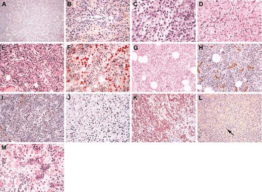 Figure 1. Histopathology of the spleen, liver, and bone marrow in hepatosplenic γδ T-cell lymphoma. In the spleen, (A) the general architecture is preserved with marked hyperplasia of the red pulp; (B) at high magnification, medium-sized neoplastic cells are located within the cords and sinuses of the red pulp (patient 15), and (C) histiocytes are admixed (patient 12), disclosing some features of hemophagocytosis. In the liver (D), neoplastic lymphoid cells infiltrate variably dilated sinusoids (patient 1). In bone marrow biopsy (E-I), the marrow is usually hypercellular (E) and exhibits an elective sinusal infiltrate composed of medium-sized atypical lymphocytes (E-F), which is more obvious in panel E (patient 7) than in panel G (patient 17). In the latter, the mild infiltrate is strongly highlighted by immunostaining showing the CD3+CD5- phenotype of the neoplastic cells (H-I). In rare instances, atypical cytology was observed at initial examination (J), with presence of pleomorphic medium and large cells within the hepatic sinusoids (patient 14). Neoplastic cells display a nonactivated cytotoxic profile with strong granular cytoplasmic staining for TIA1 (K) but absence of granzyme B expression (L), as shown in the spleen (patient 2) (the arrow indicates the rare Granzyme-B-positive lymphocytes that act as internal positive control). Cytologic features of progression with blastic appearance were observed in the heavy infiltrated bone marrow of patient 1, at relapse (M); compare the cytology with that observed in the liver at initial examination, as seen in panel D.