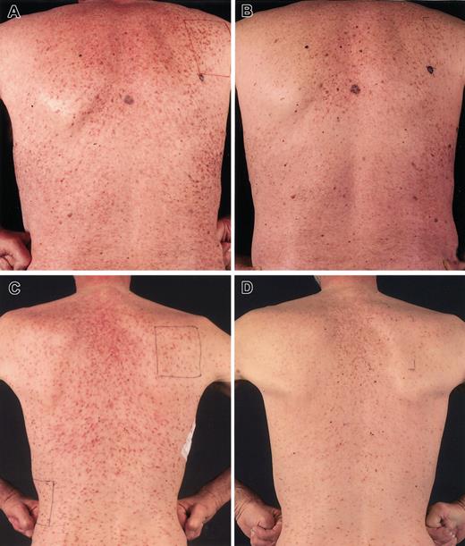Figure 1. Decrease of urticaria pigmentosa on cladribine. Remarkable reduction of urticaria pigmentosa lesions in patient A before treatment (A) and after 6 cycles of cladribine (B) and in patient D before treatment (C) and after 6 cycles of cladribine (D). Brown remnants of lesions are still seen after 6 months, consisting of predominantly melanocytes with hardly any mast cells present, confirmed in skin biopsies.