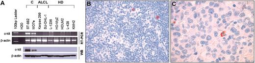 Figure 1. Absence of c-kit expression in HD and ALK-positive ALCL cell lines and tumors. (A) Top: Expression of c-kit mRNA in HD and ALCL cell lines as detected by RT-PCR as described elsewhere5 using the following primers: 5′-ACACCCTGTTCACTCCTTTGCTGA-3′ (forward), and 5′-GACTCCTTTGAATGCAGAAGA-3′ (reverse). The ST-882 and MO7e cell lines served as positive controls. Bottom: Immunoblots showing expression of c-kit protein in HD and ALCL cell lines. All HD and ALCL cell lines tested were negative for c-kit. A 145-kDa band corresponding to c-kit receptor was detected only in the ST-882 and MO7e control cell lines. β-actin served as a control for the amount of protein loaded in each well. (B,C) Representative cases of classical HD (B) and ALK-positive ALCL (C) showing no c-kit immunoreactivity in tumor cells. Note that occasional plasma cells are positive for c-kit. Original magnifications: B, × 200; C, × 400. Stained with immunoperoxidase with hematoxylin counterstain.