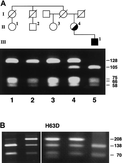 Figure 6. Restriction analysis of the proband and family members. (A) The presence of the -206C>G mutation was detected by mismatch PCR and restriction analysis with DdeI as described in “Patients and methods.” The PCR product in the presence of the mutation had an additional DdeI restriction site. Lanes 1, 2, and 3 showed the restriction fragments from healthy individuals (128, 75, 66, and 58 bp). Lane 4 shows the restricted PCR products of the heterozygous proband (128, 105, 75, 66, 58, and 23 bp), while lane 5 shows the restriction fragments from her hemizygous son (105, 75, 66, 58, and 23 bp). The 23-bp fragment is not resolved on this gel. (B) Lanes 1 and 5 show a normal pattern for Sau3AI digestion of the PCR-amplified region of the His63Asp mutation of the HFE gene (138 and 70 bp; the weak 208 bp band is due to incomplete digestion). Lanes 2 to 4 demonstrate that 3 family members are heterozygous for the His63Asp mutation (208, 138, and 70 bp).