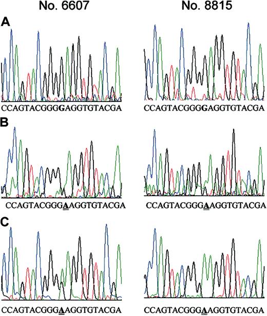 Figure 1. Point mutation Glu255Lys at the ATP binding site of the ABL kinase in bone marrow samples from patients with Ph+ ALL before treatment with STI571. A 166-bp region of ABL, which codes for the ATP binding site, was PCR-amplified using 2 primer pairs and cloned into TA-cloning vector. Sequencing of a total of 432 clones revealed the Glu255Lys mutation in 2 clones established from 2 different STI571-naive bone marrow cell samples. (A) DNA sequence of clones from the STI571-naive cells having the wild-type BCR-ABL sequence. The critical nucleotide (nt 910) is marked in bold. (B) DNA sequence of the 2 clones from the STI571-naive cells carrying the mutation Glu255Lys, which is caused by a G>A change at nt 910. The position of the mutation is underlined. (C) For comparison, clones that were derived from STI571-resistant cells from the same patients that were previously shown by direct DNA sequencing to have the Glu255Lys mutation were sequenced. The nucleotide change G>A at nt 910 was detectable in 10% to 30% of clones from STI571-resistant cells. The position of the mutation is underlined.