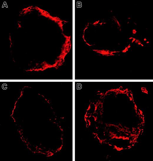 Figure 2. MYH9 localization in megakaryocytes. Immunofluorescence micrographs of the bone marrow from a healthy donor (A-B) and the patient with the Asp1424Asn mutation (C-D). Shown are 2 megakaryocytes with a typical staining of their cytoskeleton with MYH9/MYH10 antibodies in one of the 5 donors studied and the patient, respectively. Rhodamine staining. Original magnification × 1000 for all panels.